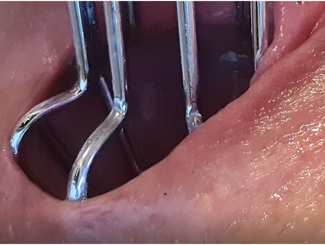 dehnungskäfig raus ziehen